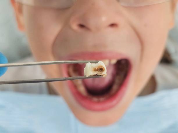 Best Emergency Tooth Extraction in Orange Blossom, CA